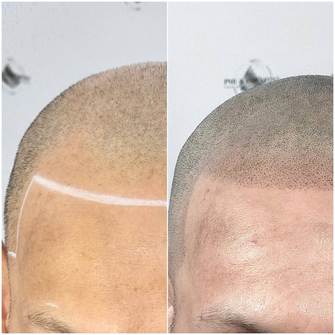 Before and after SMP hairline treatment in East London