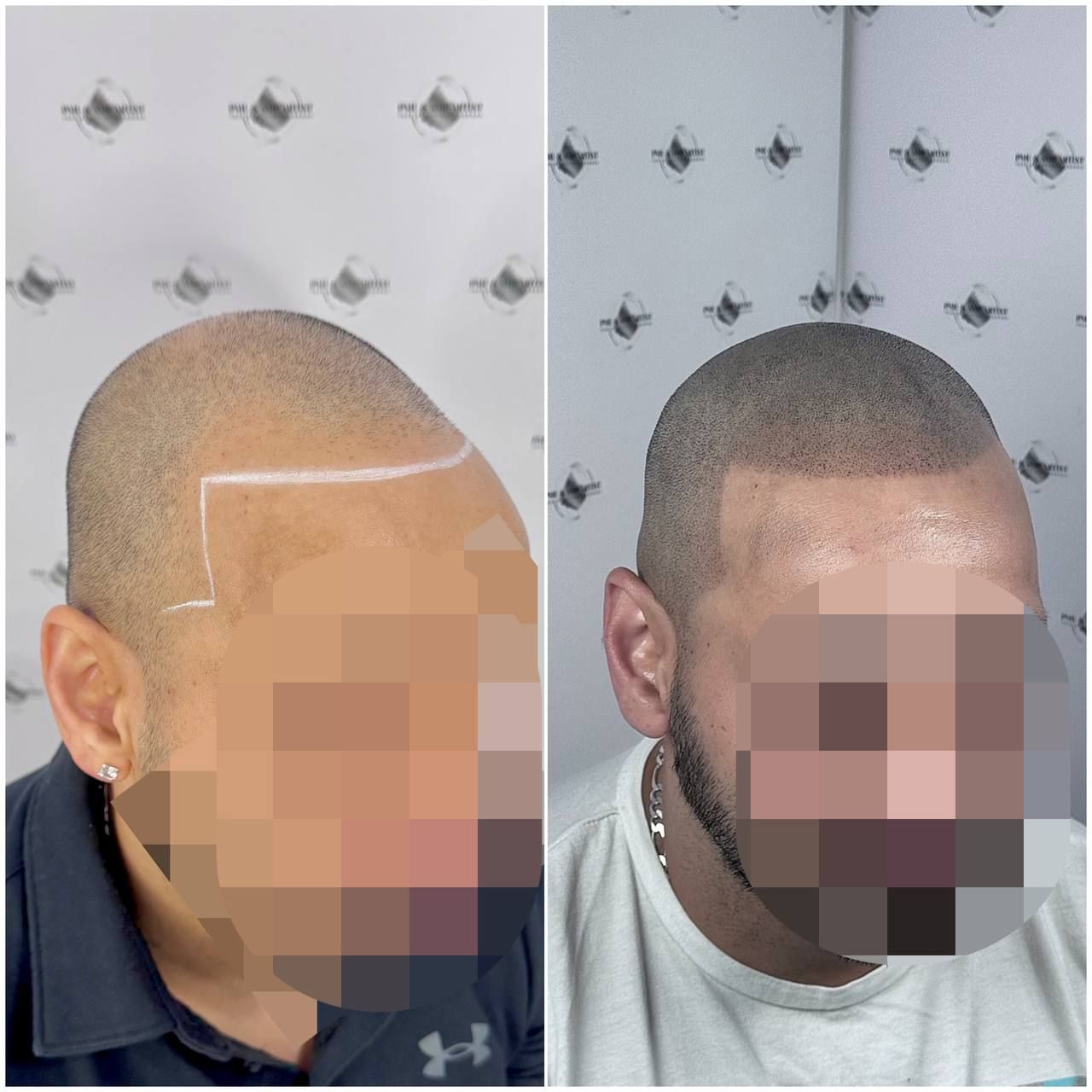 Buzz-cut SMP effect before and after