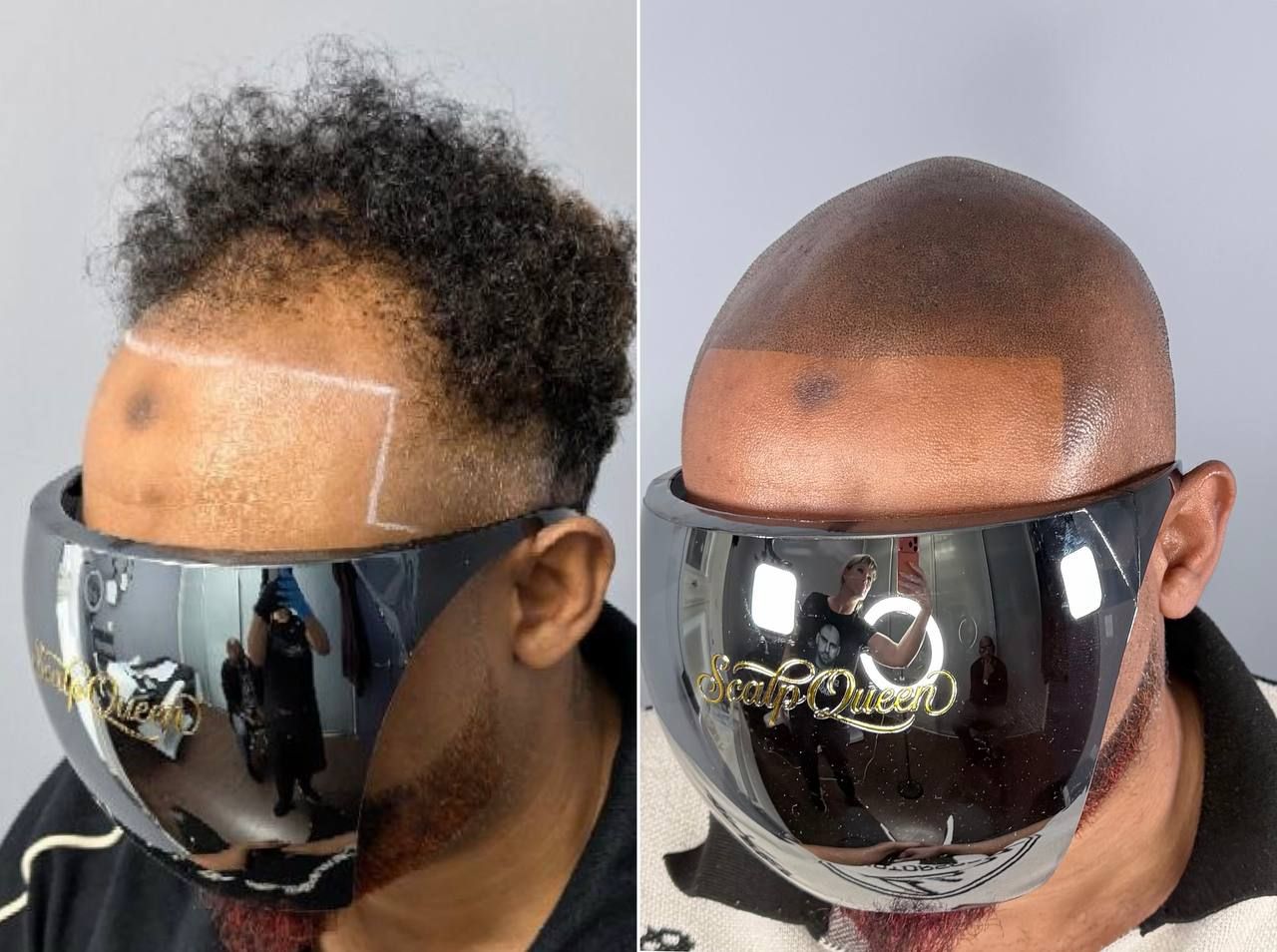 Before and after scalp micropigmentation result in East London