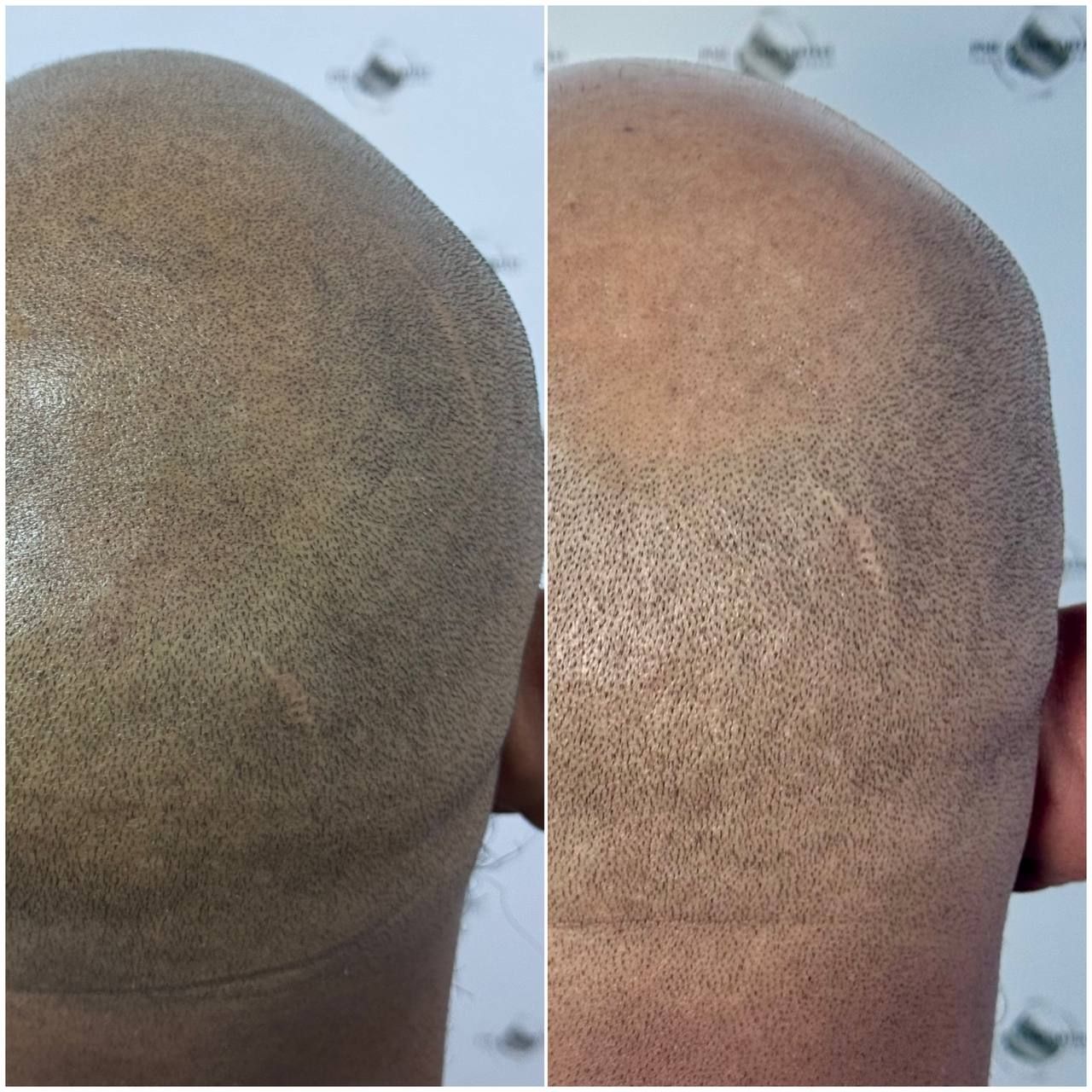 SMP crown density before and after