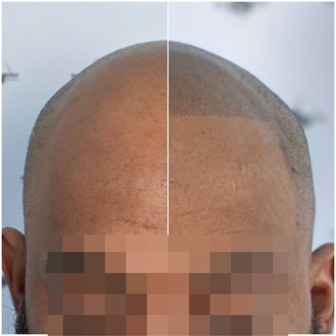 SMP density result for thinning hair on top of scalp