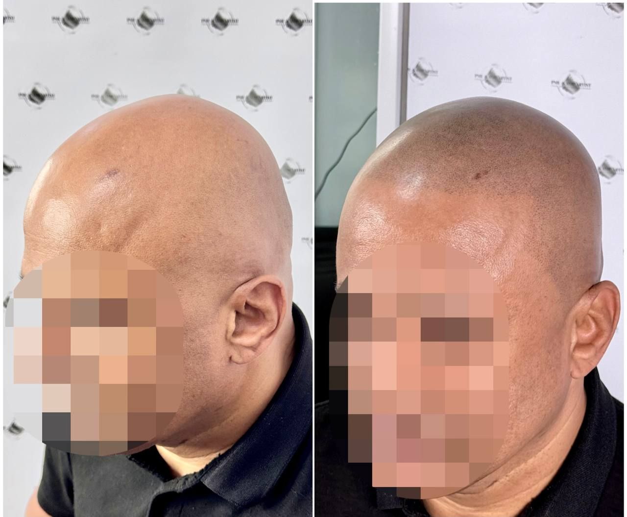 Natural SMP result for alopecia in East London